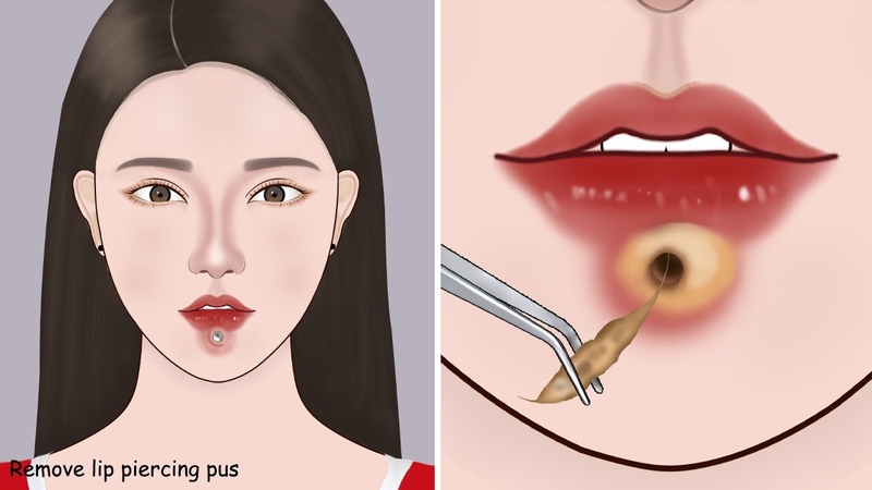 ASMR Remove unmanaged lip piercing pus, Squeeze lip