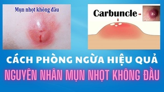 Nguyên nhân mụn nhọt không có đầu và cách phòng ngừa hiệu quả #munnhot