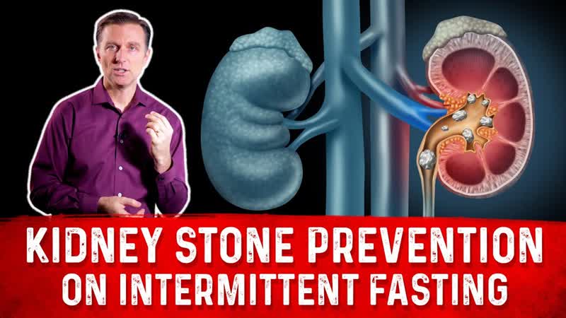 How to Prevent Kidney Stones on Intermittent Fasting (if you are susceptible) Dr.